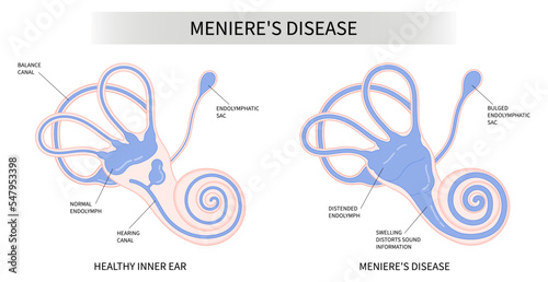The Meniere's disease of sound in stuffy ear hear ringing roaring buzzing loss of balance dizzy spells pressure headache photo