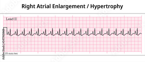 ECG Right Atrial Enlargement - 8 Second ECG Paper - Right Atrial Hypertrophy