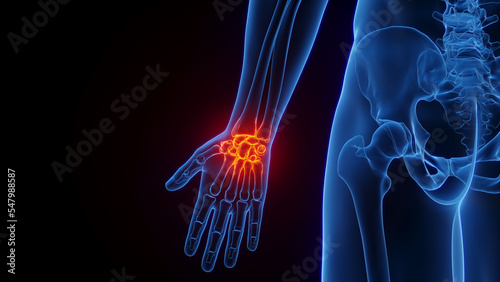 3D rendered Medical Illustration of Male Anatomy - Inflamed Wrist.