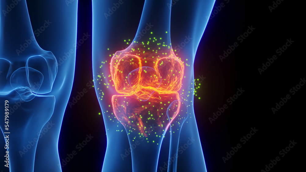 3D rendered Medical Illustration of Male Anatomy - Inflamed Knee undergoing Healing. Plain Black Background. 3D rendered Medical Illustration of Male Anatomy - Inflamed Knee undergoing Healing. Plain Black Background.