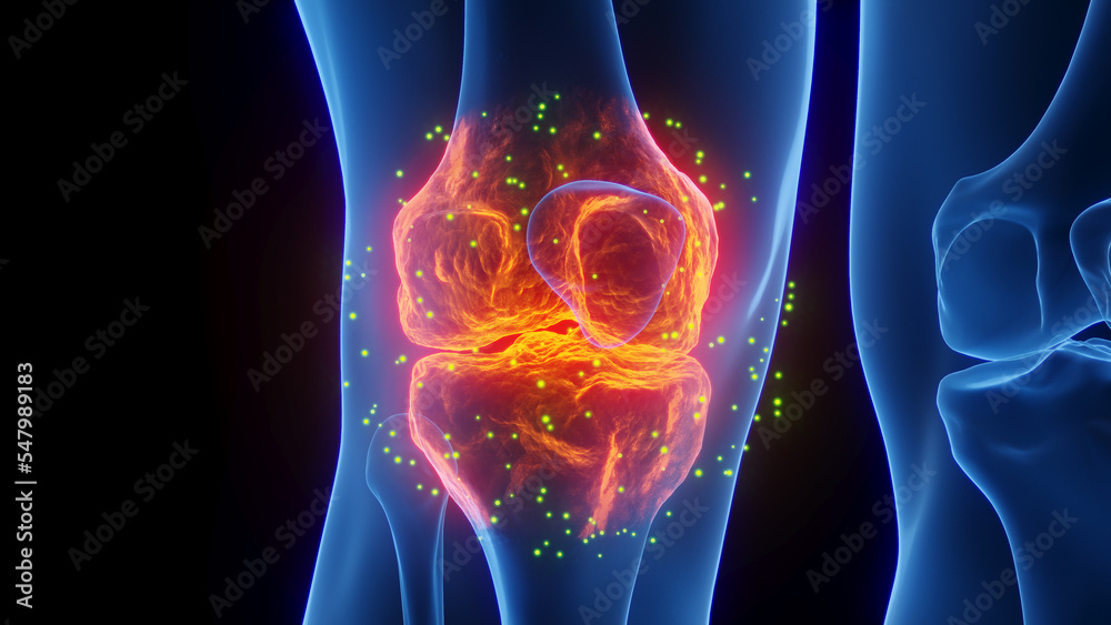 3D rendered Medical Illustration of Male Anatomy - Inflamed Knee undergoing Healing. Plain Black Background. 3D rendered Medical Illustration of Male Anatomy - Inflamed Knee undergoing Healing. Plain Black Background.