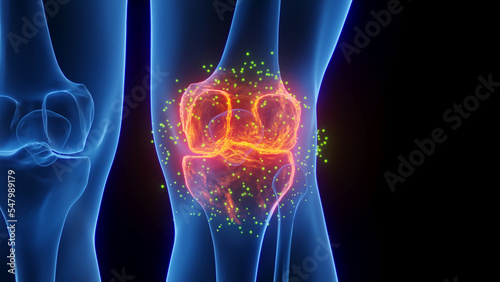 3D rendered Medical Illustration of Male Anatomy - Inflamed Knee undergoing Healing. Plain Black Background.