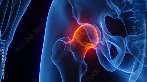 3D rendered Medical Illustration of Male Anatomy - Inflamed Hip Joint.