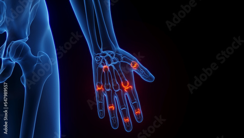 3D rendered Medical Illustration of Male Anatomy - Inflamed Hand.