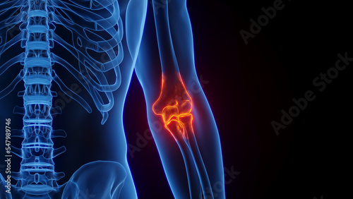 3D rendered Medical Illustration of Male Anatomy - Inflamed Elbow. Plain Black Background.