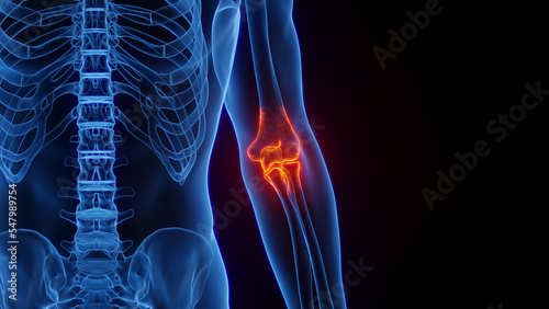 3D rendered Medical Illustration of Male Anatomy - Inflamed Elbow. Plain Black Background.