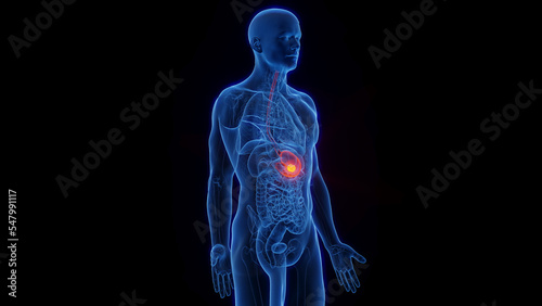 3D Rendered Medical Illustration of Male Anatomy - Stomach Cancer.