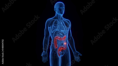 3D rendered Medical Illustration of Male Anatomy - Colon Cancer; Descending Colon. photo