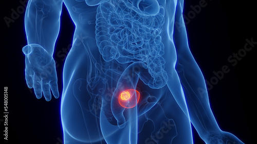 3D Rendered Medical Illustration of Male Anatomy - Bladder Cancer.