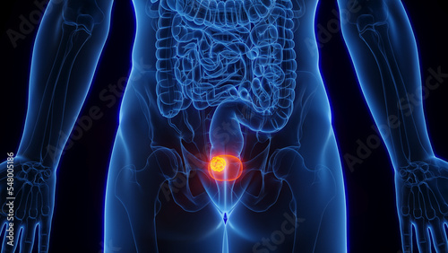 3D Rendered Medical Illustration of Male Anatomy - Bladder Cancer.