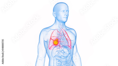 3D rendered Medical Illustration of Male Anatomy - Lung Cancer. photo