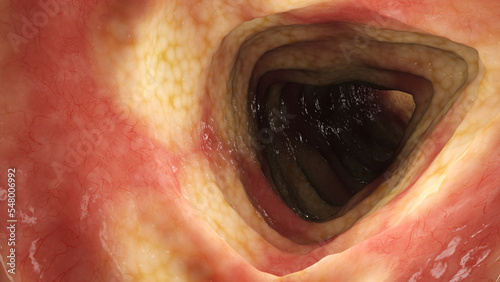 3D Rendered Medical Illustration of Crohn's Disease - Sigmoid Colon. photo