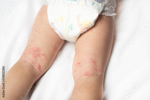 Hand, Foot, and Mouth disease rash on a baby's legs. Coxsackie virus photo