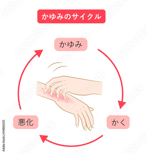 かゆみのサイクル　手湿疹