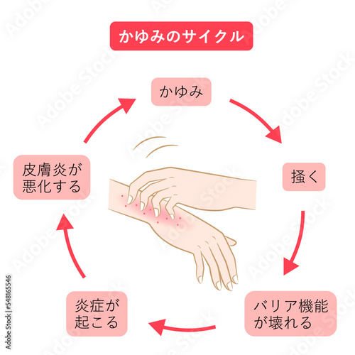 かゆみのサイクル　手湿疹
