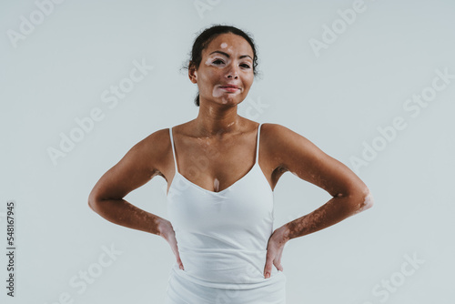 Beautiful woman with vitiligo skin posing in studio. Concept about body positivity and self acceptance photo