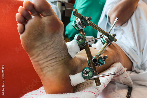Bone fracture foot and leg on femenine patient with splint clamping mechanism post surgery and orthopaedic recovery in the hospital