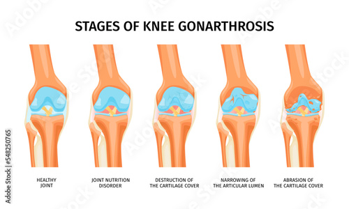 Gonarthrosis Realistic Infographics