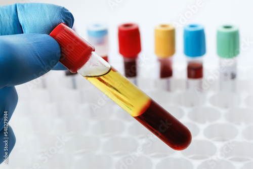 Blood drawn from a patient with Serum separate in the chemistry laboratory. Lab technician holding a test tube of blood sample after being centrifuged photo