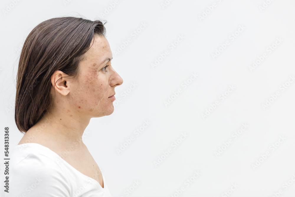 Photo of side view of woman with damaged skin. Photo of side view of woman with damaged skin.