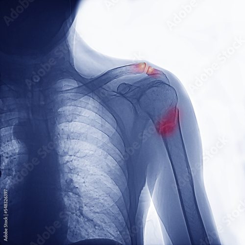 X-ray of the human shoulder joint. Fracture in the neck of the right humerus. Osteoarthritis of the acromioclavicular joint.