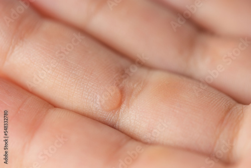 Wart on the finger. Close-up of a wart on a child's finger. The common wart Verruca vulgaris is caused by a type of human papillomavirus, HPV.