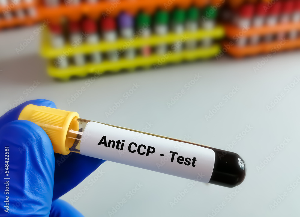 Blood sample for Anti CCP test, diagnosis of rheumatoid arthritis