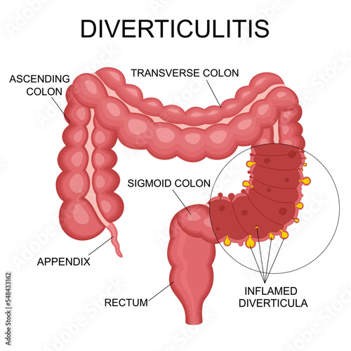 Diverticulitis and diverticulosis vector illustration. Medical structure and location. Diverticula infected or inflamed. Intestines. Bowel colon cancer, crohn's disease polyp hernia rectum