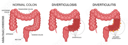 Diverticulitis and diverticulosis vector illustration. Medical structure and location. Diverticula infected or inflamed. Intestines. Bowel colon cancer, crohn's disease polyp hernia rectum photo