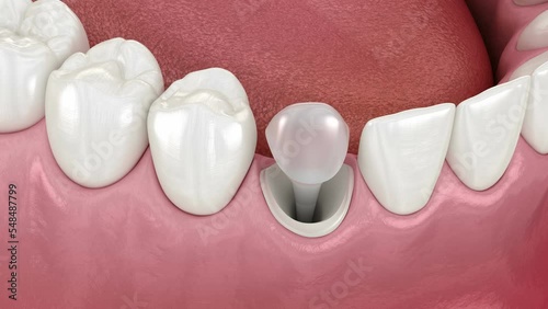 Dental stump pin tab on canaine tooth. Medically accurate dental 3D animation photo