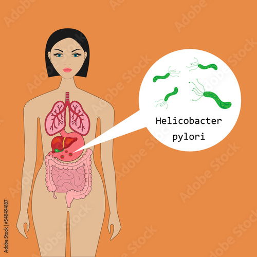 The bacterium Helicobacter pylori in the human body. Anatomy.
