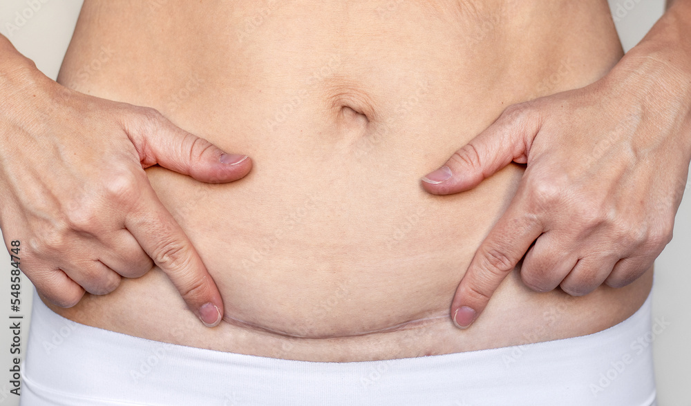 woman mother holding both hands pointing finger at the edges of cesarean surgery scar isolated.after pregnancy postpartum natal belly abdomen recovery concept fitness sport workout fat weight loss woman mother holding both hands pointing finger at the edges of cesarean surgery scar isolated.after pregnancy postpartum natal belly abdomen recovery concept fitness sport workout fat weight loss