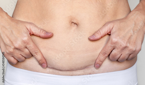 Tableau sur toile woman mother holding both hands pointing finger at the edges of cesarean surgery scar isolated