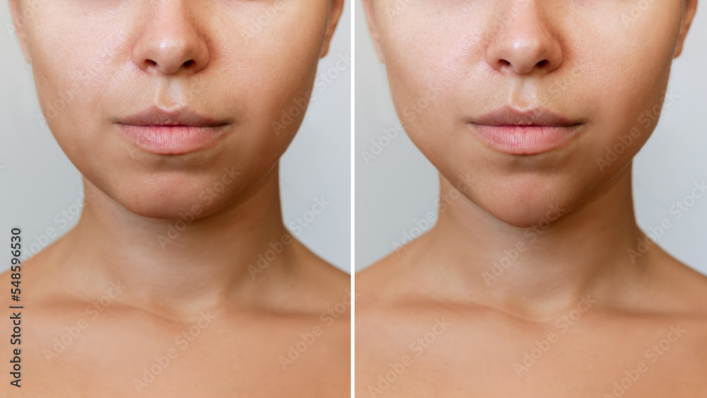© Марина Демешко - Сhin reduction with fillers. Woman's face with jaws and chin before and after mentoplasty isolated on a gray background. The result of cosmetic plastic surgery. Beauty concept