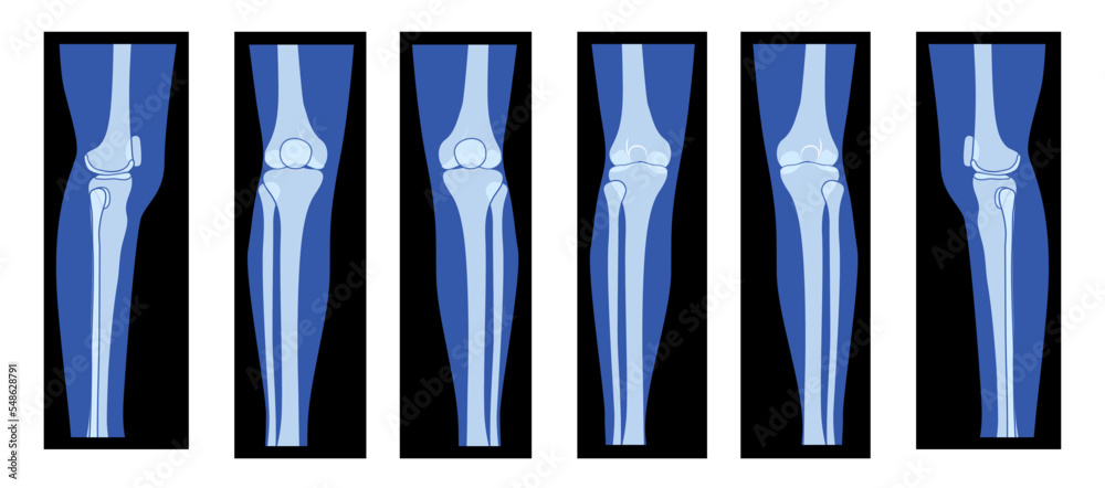 Poster Set of X-Ray Knee femur leg Skeleton Human body - Patella ...