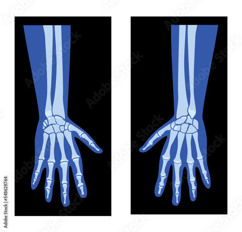 X-Ray Hands with Radius, Ulna Skeleton Human body, Bones adult people roentgen front view. 3D realistic flat blue color concept Vector illustration of medical anatomy isolated on black background