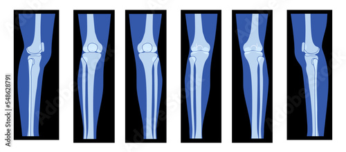 Set of X-Ray Knee femur leg Skeleton Human body - Patella, epicondyle, Tibia, Fibula Bones adult people roentgen front back side view. 3D realistic flat concept Vector illustration of medical anatomy photo