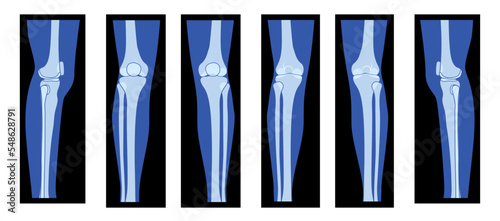 Set of X-Ray Knee femur leg Skeleton Human body - Patella, epicondyle, Tibia, Fibula Bones adult people roentgen front back side view. 3D realistic flat concept Vector illustration of medical anatomy
