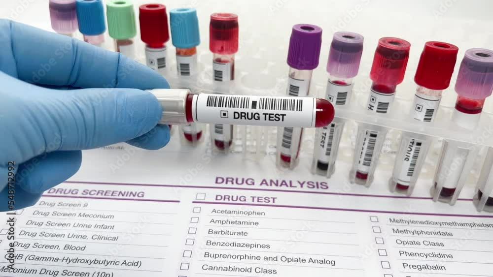 Hand doctor holding a urine and blood tube test for analysis for doping or drugs. Doctor's hand with urinalysis and blood samples for drug test or alcohol over Medical report