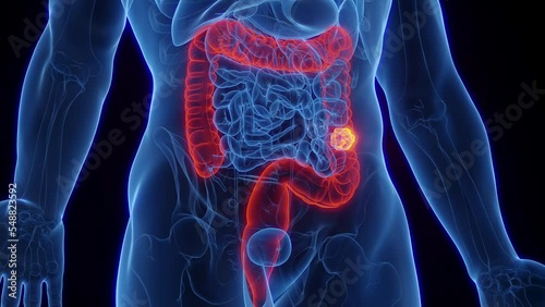 3d rendered medical animation of cancer in a man's descending colon photo