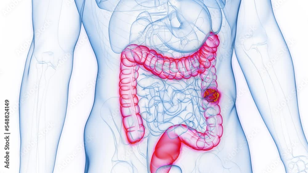 3d rendered medical animation of a neoplasm in a man's descending colon