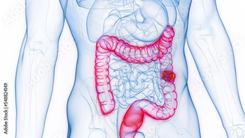 3d rendered medical animation of a neoplasm in a man's descending colon