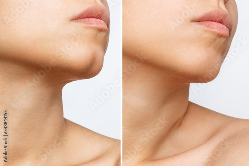 Filling the dimple on the chin with fillers. Woman's face with jaws and chin before and after dimplectomy isolated on a white background. The result of cosmetic plastic surgery. Beauty concept photo