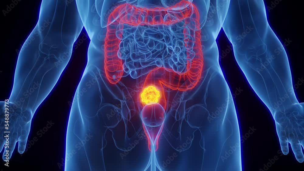 3D rendered medical animation of a malignant mass in the rectum of an adult male human. 3D rendered medical animation of a malignant mass in the rectum of an adult male human.