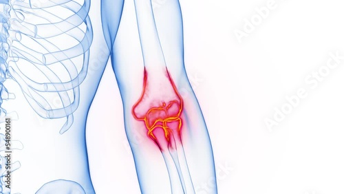 3D rendered Medical Animation of inflamed bones of the left elbow. photo