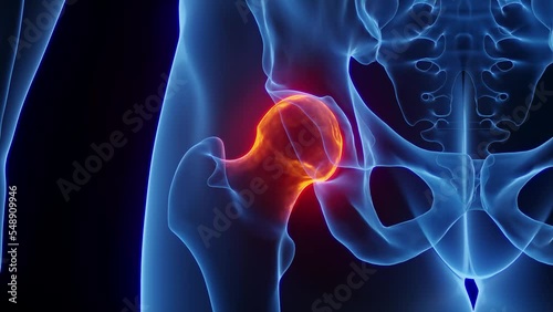 3D rendered Medical Animation of a man's inflamed right hip joints.