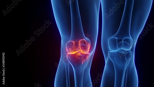 3D rendered Medical Animation of arthritis at a man's right knee joint. photo