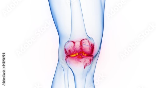 3D rendered Medical Animation of inflammation at a man's right knee joint. photo