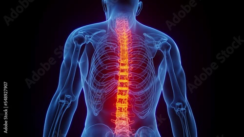 3D rendered Medical Animation of a man's inflamed backbone.