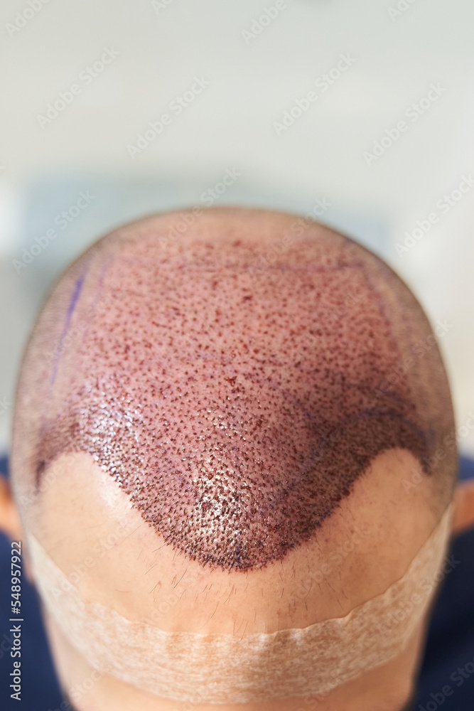 Vertical shot of hair line on male scalp after hair transplant surgery Vertical shot of hair line on male scalp after hair transplant surgery
